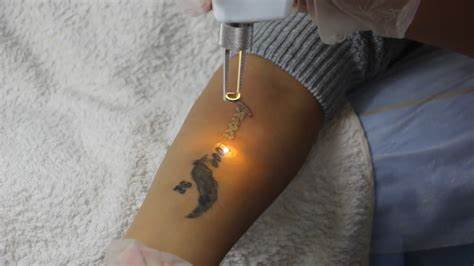 Choosing the Right Laser Tattoo Removal Technique: Options Available in Coventry